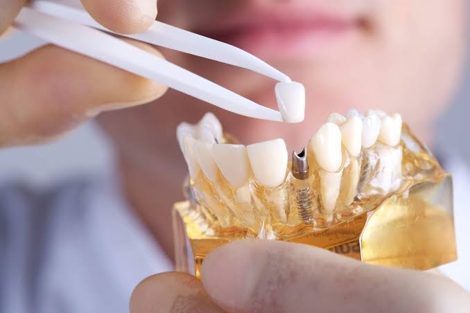 Implantes dentários e reabilitação oral